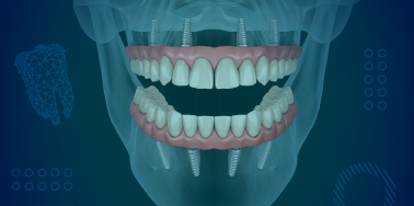 "All on Four" System with Acrylic Hybrid Fixed Denture (Upper or lower arch) **
